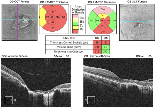 Figure 2 The OCT image of the first case. The examination revealed macular thinning in both eyes. The average thickness of the left eye (right) was thicker than the right eye (left). The SD-OCT reveals thinning of retinal layers and epiretinal membrane formation in the left eye.