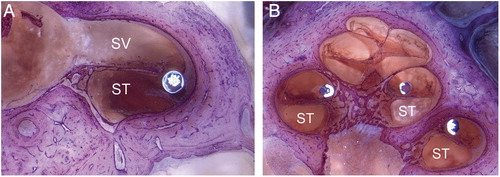 Figure 7. Showing Specimen 3 with (A) electrode entering scala vestibuli and (B) final perimodiolar position in scala vestibuli. Images courtesy of CRC Hear, Melbourne, Australia. ST, scala tympani; SV, scala vestibuli.