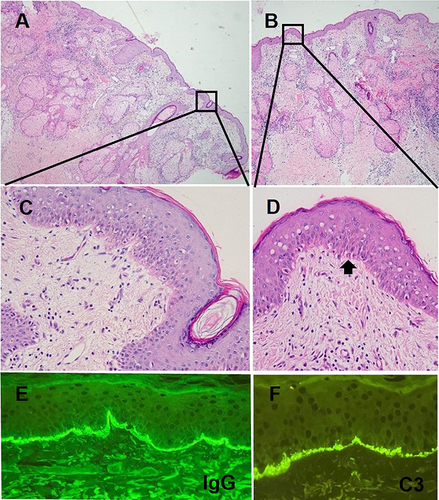 Figure 2 Pathological pictures of the skin lesion. (A and B) show the pathological pictures of the facial lesion of the patient at 4x magnification using hematoxylin and eosin (HE) staining. (C and D) show the pathological pictures of the facial lesion of the patient at 10x magnification using HE staining. The HE staining pictures revealed hair follicle plugging, vacuolar degeneration of basal cells with Civatte bodies, indistinct interface, lymphocytic infiltration around superficial and deep dermal vessels and cutaneous appendages, edema in the superficial dermis with widened collagen bundle gap. The arrow in (D) indicates a Civatte body. Panels (E) and (F) are the direct immunofluorescence (DIF) pictures of the facial lesion of the patient at 10x magnification using IgG and C3 antibodies respectively. DIF pictures revealed a characteristic lupus band at the basement membrane zone (BMZ).