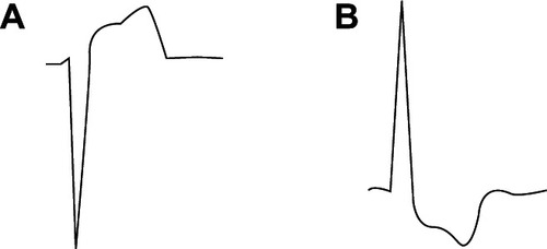 Figure 5 Our patient’s EKG reading from lead V4 A) showed a classical ventricular hypertrophy pattern when inverted by 180° B) which indicated that the anterior lead ST elevation was a reciprocal change reflecting septal hypertrophy.