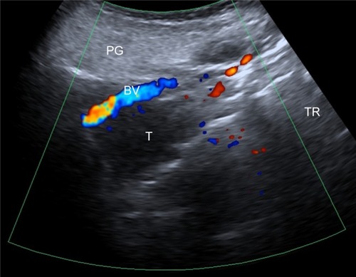 Figure 1 Color Doppler ultrasonography imaging of NPC in a 60-year-old female. Notes: A large focal mass was detected in the nasopharynx; the parotid gland and cervical blood vessels were used as acoustic windows.