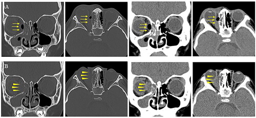 Figure 1. (A) Sinus CT images (coronal and axial views) obtained at the time of admission. Fluid collection with gas within is observed in the subperiosteal space of the right orbital medial wall (arrow). (B) Sinus CT images (coronal and axial views) obtained on the 7th day of hospitalization showing destruction of the right orbital medial wall (arrow head). CT: computed tomography