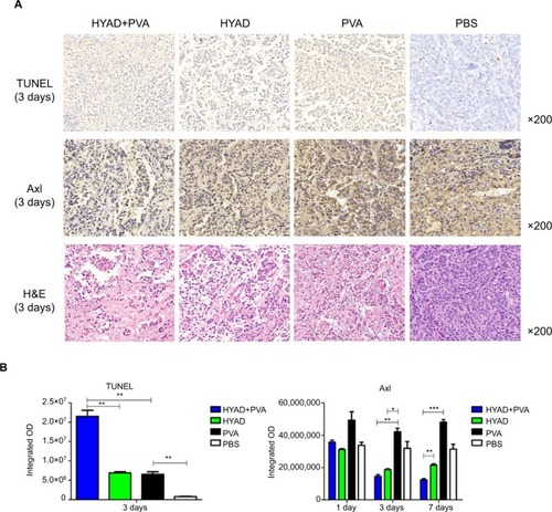 Figure 7 TUNEL assay and tyrosine kinase Axl staining.Notes: (A) Rabbits were sacrificed, and the tumors were collected on the days 1, 3, and 7 after the first interventional manipulation. TUNEL and H&E staining on day 3 and Axl staining at days 1, 3, and 7 in each group were performed. (B) Semiquantitative analysis of the staining by integrated OD demonstrating the expression levels in different groups. Each data point indicates mean ± SD. *P<0.05; **P<0.01; ***P<0.001.Abbreviations: HYAD, hypoxia-replicative oncolytic adenovirus; HYAD+PVA, HYAD combined with PVA particle embolization; PVA, polyvinyl alcohol.