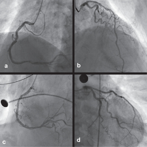 Figure 2 In case one, noncritical, distal lesions of the right coronary artery (RCA) (a) and noncritical atherosclerotic lesions of the left main coronary artery (b) did not correspond with the wall motion abnormality observed on ventriculography. In case two, there was no evidence of coronary arterial stenosis of either the RCA (c) or the left anterior descending artery (d).