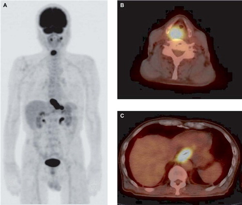 Figure 1. A. Maximum intensity projection (MIP). B,C. Transaxial PET/CT. A 79-year-old man (Case 11). An FDG-PET/CT image shows focal FDG uptake on the right side of the hypopharynx (SUVmax, 13.4). An additional FDG uptake is observed from the lower thoracic to abdominal esophagus (SUVmax, 33.2); this uptake was confirmed to represent an esophageal squamous cell carcinoma (T3).