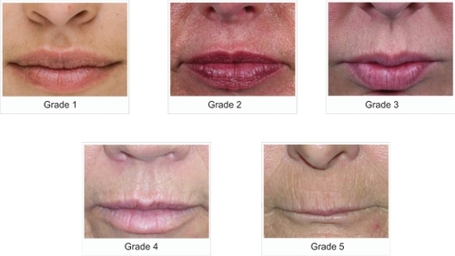 Figure 2 Five-point photonumeric scale used for upper lip atrophy.