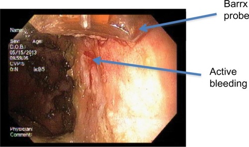 Figure 4 Post-radiofrequency ablation with Barrx probe (case 2).