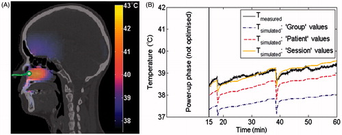 Figure 1. Predicted 3D temperature distribution on the planning CT shown together with the catheter track (solid green line) with a measurement probe at the tip inside the challenging-to-heat nasopharynx tumour (A). As illustration, we show the temperature during treatment (B) for the temperature measured at the tip (solid black) compared with the predicted temperatures using Group (dash-dot purple), Patient (dashed red) and Session (solid orange) parameter values, when six parameters were optimised using an applicator efficiency factor of 100%. Results for an applicator efficiency factor of 40% were similar and therefore not shown.