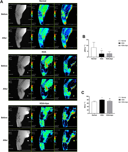 Figure 2 Acupotomy relieved the state of hypoxia. (A) Representative T2* images and pseudo-color T2* images and pseudo-color R2* images in each group. And ROIs used to delineate the synovium to derive reactivity maps of normoxia and hyperoxia (using a mixture of 95% oxygen (O2) and 5% carbogen (CO2) for hyperoxia stimulus). (B) Δ R2* changes between groups. *P < 0.05 vs the Normal group. (C) R2* changes between groups. **P < 0.01 vs the Normal group. ##P < 0.01 vs the KOA group.