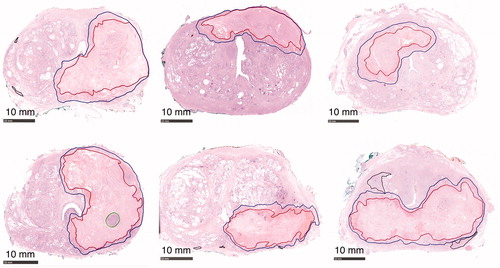 Figure 1. Annotated H&E stained axial whole-mount slide mid from the RALP specimen from every study patient. All patients except patient four presented complete coagulation necrosis of the targeted tumor: the complete irreversible cell death inside the red boundary (CNZ) and margin zone between red and blue boundaries (MZ). Patient 4 presented thermally-fixed viable-looking cells within green boundaries. Black contoured regions present outfield (outside treatment boundaries) residual prostate cancer.