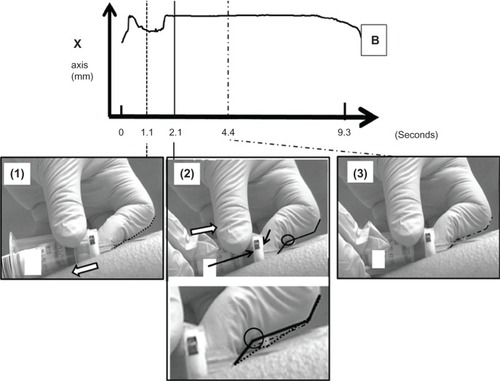 Figure 3 Characteristic movements used to grasp the holder: the first blood collection tube is detached (1); reinsertion of the blood-collection tube; the second finger of the left hand is pushed back so that the needle does not advance too much (2); the blood-collection tube is held with both hands (3).Note: B stands for the point at the bottom of the rubber base of the tube.