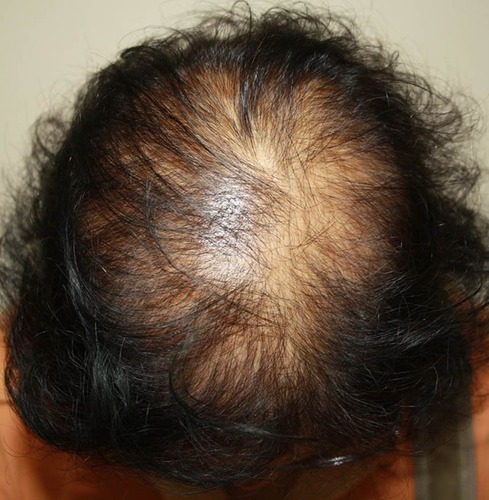 Figure 1 Female pattern hair loss: hair thinning mostly confined to the crown with retention of frontal hairline.