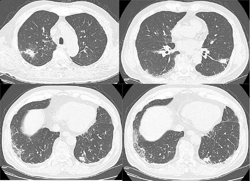Figure 4 CT Chest on April 27th, 2023 (a decrease in bilateral lung consolidation, with some reduction in cavitary and interstitial changes compared with CT Chest on April 11th, 2023).