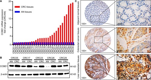 Figure 1 CCBE1 expression in CRC patients.Note: The expression of CCBE1 was detected in 30 fresh CRC tissues and matched AN tissues by qRT-PCR (A), Western blotting (B) and IHC (C).Abbreviations: AN, adjacent normal; CRC, colorectal cancer; IHC, immunohistochemistry; qRT-PCR, quantitative real-time PCR.