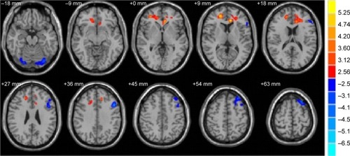 Figure 2 Significantly altered MD values in patients with Stra compared with HCs.