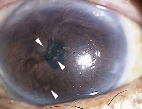 Figure 3 Recurrent lesions. The recurrent lesions can be seen in different areas of cornea. Spiral-shaped corneal surface is due to limbal stem cell deficiency.