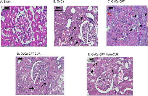 Figure 3. Histopathology of the kidney in ovarian-cancer rats treated with cisplatin or cisplatin- curcumin or cisplatin-nanocurcumin. Magnification: 400×. The red arrow indicates the presence of congestion; the black arrows indicate the presence of necrosis.