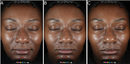 Figure 5 (A–C) Improvement in skin radiance and texture in a 32-year-old female who received the DG plus HA5 serums combined treatment. Digital photographs were taken with parallel polarized light at the following timepoints: before treatment (A), at week 2 (B), and at week 12 (C).