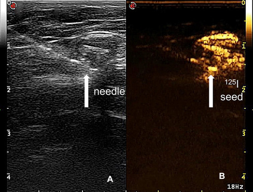 Figure 4 The 125I seed implantation process. (A) The needle (arrow) can be seen directly in ultrasound. (B) The 125I seed (arrow) was implanted in the enhanced SLN.
