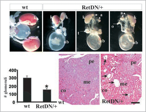 Figure 3 Hypomorphic Ret allele provides evidence that varied Ret signaling is associated with different CAKUT manifestations. (Top row), Compared with wild-type (wt) mice, RetDN/+ mice (express a Ret form with severely reduced, but not absent, Ret-Y1062 signaling) showed a spectrum of renal defects including bilateral small kidneys and unilateral renal agenesis (k, kidney; a, adrenal; ub, urinary bladder, t, testis; o, ovary; adrenal gland, arrowhead). (Bottom row) Bar graph shows decreased total number of glomeruli in RetDN/+ kidney at birth (n = 3 animals, 5 kidneys) compared with wild-type litter mates (n =3 animals, 6 kidneys) (*p < 0.001, mean ± s.e.m). H&E-stained sections show tubulocystic degeneration (arrows) in approximately 50% of 3- to 4-week-old RetDN/+ mice (6 of 12) (co, cortex; me, medulla; pe, pelvis). Scale bar = 5 mm in top row, and 600 µm in bottom row. The figure is adapted from Jain et al.Citation40 with permission.
