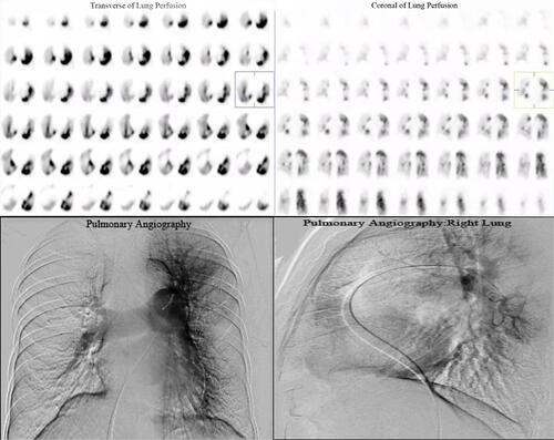 Figure 3 Pulmonary perfusion imaging of a patient (female, 68 years old) with chronic thromboembolic pulmonary hypertension (CTEPH). The imaging orientation of the left upper, right upper was in the transverse, coronal plane of lung perfusion imaging. The imaging orientation of the left lower and right lower was pulmonary angiography and pulmonary angiography of the right lung, respectively. A total of 11 pulmonary segment defects inclusive of the posterior segment, apical segment, and anterior segment of the right upper lobe, medial segment and lateral segment of middle lobe, posterior basal segment, lateral basal segment, and anterior basal segment of the lower lobe, as well as the anterior segment, superior lingular segment, and inferior lingular segment of the left upper lobe, were diagnosed using pulmonary perfusion imaging. A total of 12 pulmonary segment defects in all segments of the right lung and lingual segments of the left lung were diagnosed using pulmonary angiography. Using the chi-square test/Fisher’s exact test, P = 0.013, the difference was statistically significant.