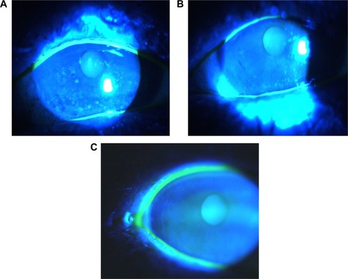 Figure 3 Corneal staining pictures
