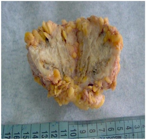 Figure 1 Gross appearance of the surgical specimen.