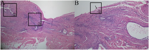 Figure 6. (a)White lesion (HE × 100). (b) White lesion (HE × 400).White lesion: The ectopic lesions were located in the subperitoneum, and most of the glands were micro glands with narrow cavities and few stromal cells surrounding the glands; however, small glands were occasionally visible, as indicated in (a) marker ①; the lesions were mainly composed of fibrous tissue, as indicated in (a) marker ②; and the peritoneal mesothelial tissue structure was destroyed and almost invisible, as indicated in (b) marker ①.