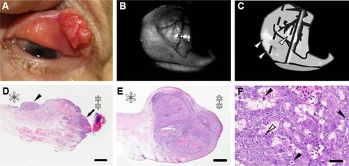 Figure 5 Case 7: an 89-year-old woman with sebaceous carcinoma.
