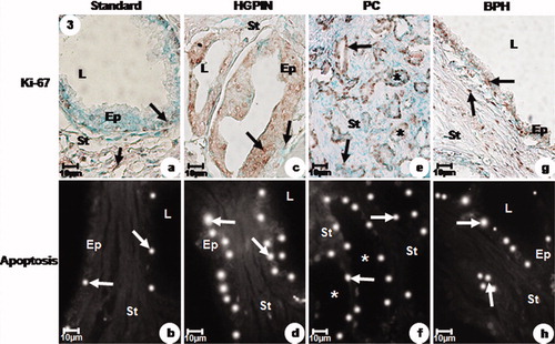 Figure 3.  Immunolabelled Ki-67 and apoptotic index of the prostatic peripheral zone from standard (a, b), HGPIN (c, d), PC (e, f) and BPH (g, h) groups. (a) Weak Ki-67 immunoreactivity (arrows) in the secretory epithelial and stromal cells. (b) Weak DNA fragmentation (arrows) in the secretory epithelial cells. (c) Intense Ki-67 immunoreactivity (arrows) in the secretory epithelial and stromal cells. (d) Intense DNA fragmentation (arrows) in the secretory epithelial cells. (e) Intense Ki-67 immunoreactivity (arrows) in the neoplastic acini (asterisks) and stromal cells. (f) Moderate DNA fragmentation (arrows) in the neoplastic acini (asterisks). (g) Moderate Ki-67 immunoreactivity (arrows) in the secretory epithelial and stromal cells. (h) Moderate DNA fragmentation (arrows) in the secretory epithelial cells. a–h: Ep, epithelium, L, lumen and St, stroma.