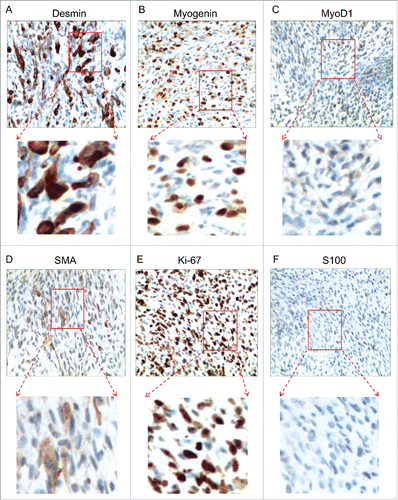 Figure 2. Immunohistochemical staining. Immunohistochemical staining showed positivity for Desmin, Myogenin, MyoD1, SMA, Ki-67, while negativity for S100.