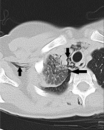 Figure 3 Axial nonenhanced chest CT scan.