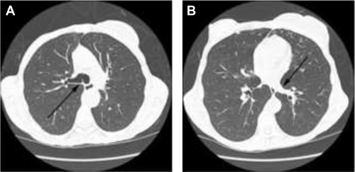 Figure S2 Craniocaudal division of the lungs.Notes: Noncontrast transaxial CT image on lung windows of a 65-year-old female subject with mild centrilobular emphysema. (A) Black arrow denotes the carina (the boundary between the upper and mid lung zones). (B) Black arrow denotes the cranial most inferior pulmonary vein ostia (the boundary between mid and lower lung zones).Abbreviation: CT, computed tomography.
