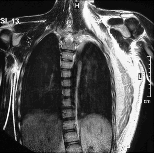 Figure 4. MRI showing a diffuse edematous swelling clearly demarcating the serratus anterior muscle.