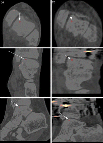 Figure 3. Weight points for registered distal tibia of patient 1. (a) Axial, coronal, and sagittal slices from the original CT-A volume from the first scan date. (b) Axial, coronal, and sagittal slices from the FVOL-3 volume derived from registering the distal tibia from FVOL-2 (proximal tibia registered) with the original (CT-A) distal tibia. The weight points, derived from the landmarks, are shown on each slice (white arrows). Over the period of 33 weeks, the elongation of the tibia was approximately 34 mm and the rotation was approximately 10°.
