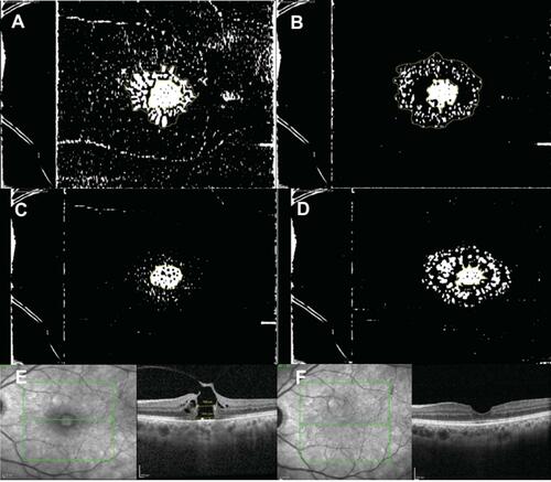 Figure 3 Group 1; (A) Binarized en face scan of the outer plexiform layer (OPL), with an outer yellow outline of the area of the cyst and inner yellow outline of the area of macular hole. The area between the two yellow outlines denotes the area of OPL cysts (B) Binarized en face scan of the inner nuclear layer (INL), with an outer yellow outline of the area of the cyst and inner yellow outline of the area of macular hole. The area between the two yellow outlines denotes the area of the OPL cyst. (C) Binarized en face scan of the base diameter, with the area marked in yellow. Note the positive correlation in the INL and OPL area and between the basal diameter and OPL/INL cyst area. (Figures 2 and 3) (D) Binarized en face scan of the minimum inlet diameter of the hole, with the area marked in yellow. (E) Cross-sectional spectral-domain optical coherence imaging (SD-OCT) showing preoperative ellipsoid zone (EZ) and external limiting membrane (ELM) loss. (F) Cross-sectional SD-OCT image showing the postoperative ELM and EZ loss.