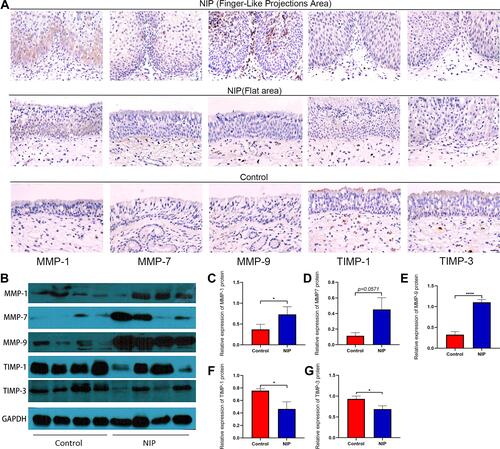 Figure 3 Expression and distribution of MMP-1/7/9 and their inhibitors TIMP-1/3 in NIP tissue. (A) immunohistochemical staining for MMP-1/7/9, TIMP-1/3 in nasal inverted papilloma, all pictures were shown as ×400 magnification (scale bar = 20μm). (B) Representative Western blotting image for MMP-1/7/9, TIMP-1/3 and housekeeping GAPDH from total protein extracted from NIP and healthy control tissue (healthy control n = 8, NIP n = 8). (C–G) MMP-1/7/9, TIMP-1/3 relative protein expression levels in healthy control and NIP tissue, the data were analyzed using ImageJ and shown as mean ± SD. Statistical significance was analyzed using student’s t-test, *p<0.05, ****p<0.0001.