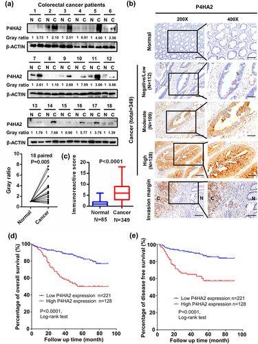 Figure 1. P4HA2 expression is upregulated in CRC tumor tissues and related bad clinical outcomes.