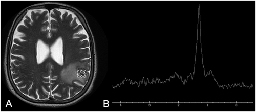 Figure 5 A 65-year-old man presented with headache and seizures. Brain MRI demonstrated a heterogeneous lesion on T2-weighted imaging in the left parietal lobe (A). (B) Proton 1H-spectroscopy of the lesion, with a short echo time (35 ms), showed a lipid peak, at 1.3 ppm, and absence of choline and N-acetylaspartate peaks. The histopathological diagnosis was PCM.