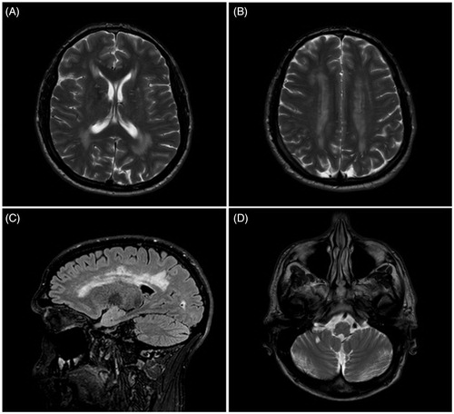 Figure 1. MRI brain scan from the patient with concurrent Fabry’s disease and amyotrophic lateral sclerosis. (A and B) T2 weighted transverse MRI scan showing symmetrical white matter change; (C) Sagittal FLAIR MRI scan showing white matter changes in the cerebral hemispheres; and (D) T2 weighted transverse MRI showing white matter changes in the brainstem.