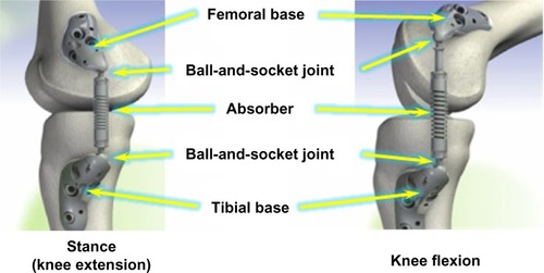 Figure 1 Schematic views of the KineSpring system and its components implanted medially to the knee (right knee shown). Note the compression of the absorber (active load-carrying) in knee extension (left image), and the elongation of the absorber (passive, non-load-carrying) in flexion (right image).