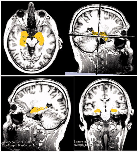 Figure 6. Data checking. The images are arranged in the order they are displayed in 3D Slicer. The top right square shows the viewport with 3D model representation against the axial, coronal, and sagittal MRI scans (2D) which can be scrolled to specific image. These are then displayed in the other three viewports (top left, bottom left, bottom right) in 2D where they also show the highlighted 3D representation.