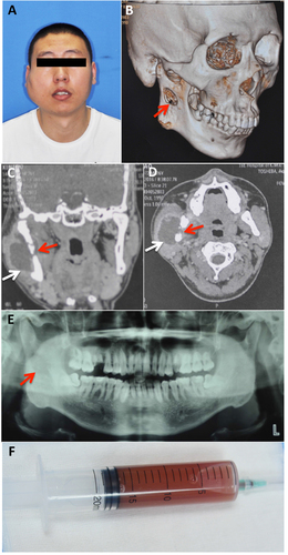 Fig. 6 Clinical material of a HNTB patient—the case report.a Frontal photograph. b–d Computed tomography results. e Panoramic tomography results. f Liquid aspirate from the lesion site. White arrows: HNTB lesion; Red arrow: mandibular involvement