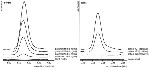 Figure 2. Analytical data (extracted ion chromatograms, equally scaled for direct comparison) of nebivolol in serum and urine. Patient #23, #24 and #26 exhibited similar serum concentrations and were considered adherent according to the DRC approach. In comparison, the urinalysis was considered positive for patients #23 and #24 but negative for patient #26.