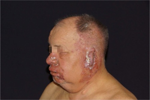 Figure 1 Initial presentation of the patient with temporal herpes zoster.