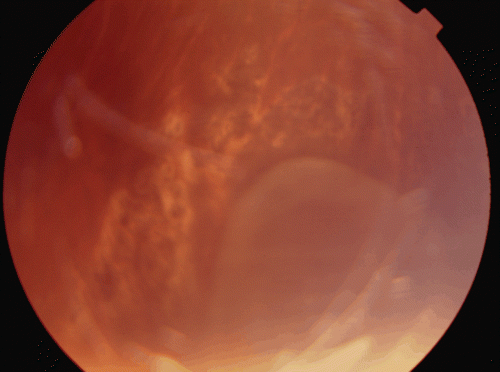 FIGURE 2  Fundus picture of patient 2 following photocoagulation. Note that laser spots form a barrier around the bullous retinoschisis.