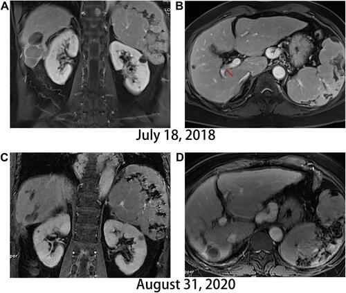 Figure 1 Contrast imaging of primary liver lesions on MRI subsequent to sorafenib-regorafenib therapy combined with sintilimab. (A) The largest liver lesion in Segment 6 at admission. (B) A posterior portal vein tumor thrombus indicated by the arrow at admission. (C) Tumor in Segment 6 is rendered inactive by treatment. (D) Disappearance of PVTT.