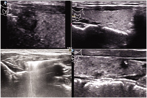 Figure 1. (A) This patient had PTMC (0.6 × 0.6 cm) in the right lobe of the thyroid before MWA. (B) The left lobe of the thyroid was intact. (C) MWA treatment of the right lobe. (D) 35 months after treatment, the patient developed PTMC in the left lobe.