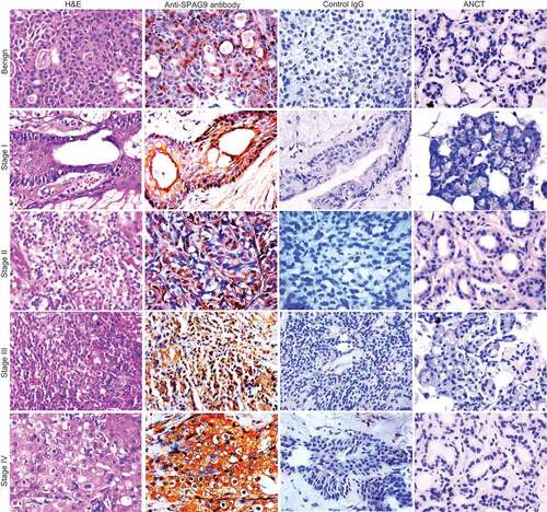 Figure 3 Validation of SPAG9 protein expression in various stages of SGT by immunohistochemistry. First panel shows representative images for H&E staining in benign, malignant stage I, II, III, and IV tumor specimens. Second panel shows the representative images for the cytoplasmic localization of SPAG9 protein probed with anti-SPAG9 antibody as depicted by brown color immunoreactivity. No immunoreactivity was observed in serial tumor sections probed with control IgG, as shown in the third panel. Fourth panel depicts no immunoreactivity against SPAG9 protein in ANCT specimens when probed with anti-SPAG9 antibody. Original magnification: x400; objective: x40.