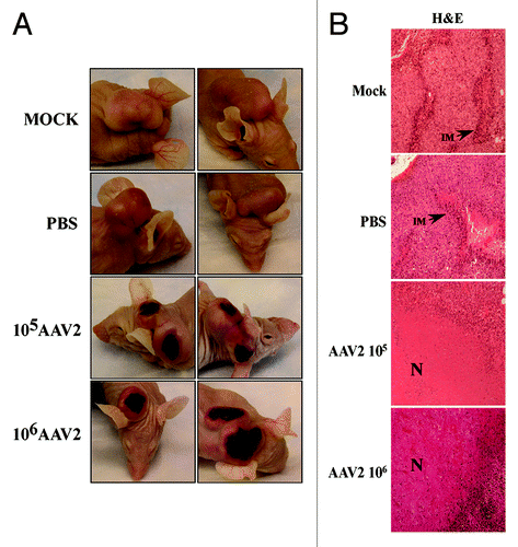 Figure 6. AAV2 infection of MDA-MB-435 tumors induced tumor necrosis which correlates with growth inhibition. (A) AAV2 infection of MDA-MB-435 xenografts induced dark patches of necrotic areas on the skin surrounding the tumors. (B) Tumors were examined using H&E staining. Mock and PBS-injected tumors were compared with AAV2-injected tumors (magnification, 100×). Both mock and PBS-injected tumors show areas of infiltrating macrophages (IM) as indicated with arrows, whereas AAV2-treated tumors show large areas of tumor necrosis (N) that correlate with the appearance of darkly staining patches on the external surface.